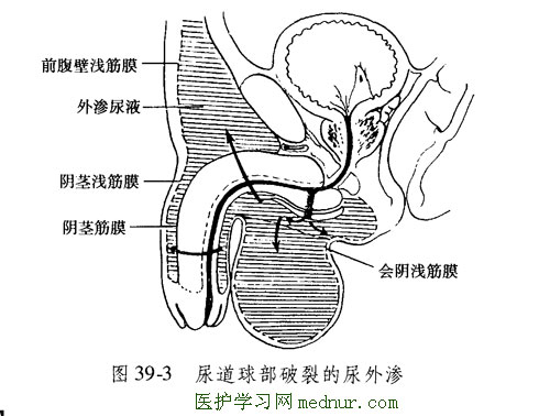 尿道球部破裂的尿外渗