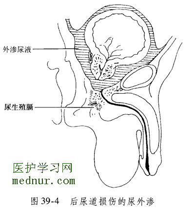 后尿道损伤的尿外渗