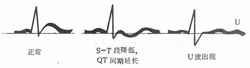 低钾血症心电图