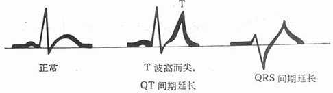 高钾血症心电图