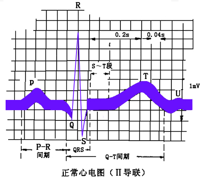 心电图