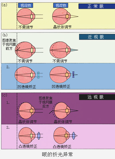 眼的折光异常